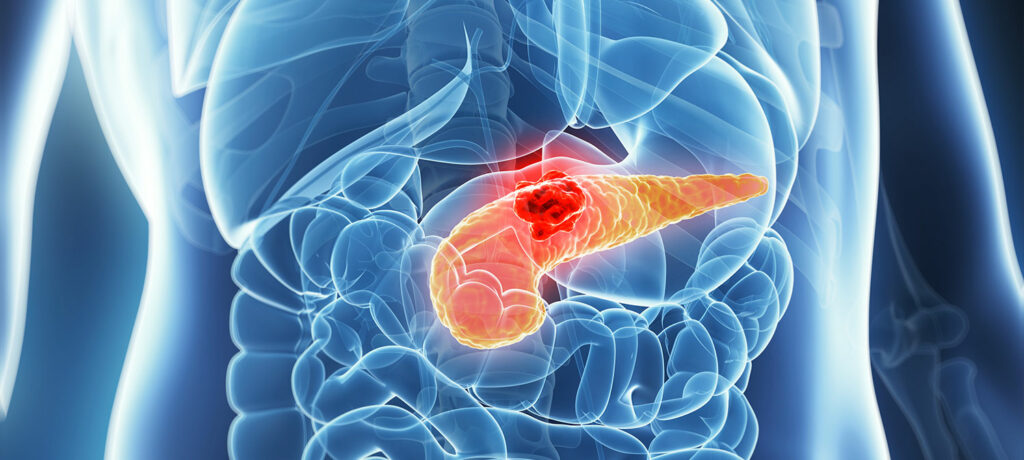 transplantation pancréatique